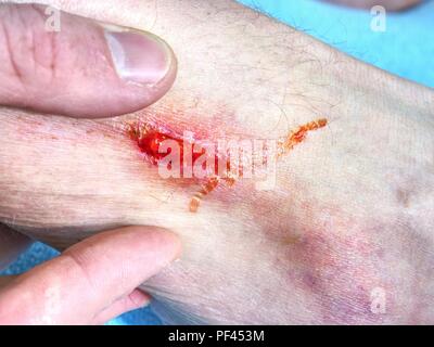 Hand embracing injured leg with painful place.  Doctor hand healing bloody  area. Fresh Abrasion. Deep wound on the skin. Stock Photo