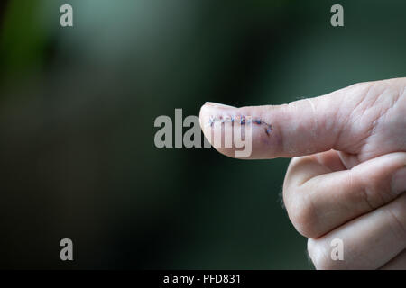 hand with stitches from surgery to repair damage Stock Photo