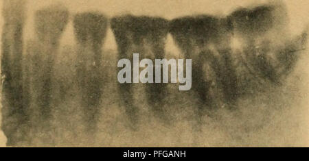 . Das Gebiss des Menschen und der Anthropomorphen; vergleichend-anatomische Unter-suchungen. Zugleich ein Beitrag zur mensch-lichen Stammesgeschichte. Teeth; Human beings; Primates. Fig. 66. Verlag von Julius Springer, Berlin.. Please note that these images are extracted from scanned page images that may have been digitally enhanced for readability - coloration and appearance of these illustrations may not perfectly resemble the original work.. Adloff, Paul. Berlin, J. Springer Stock Photo
