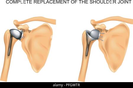 vector illustration of the types of prosthesis of shoulder Stock Vector