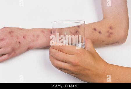 Glass held on child's arm covered in purple rash (glass test for meningitis), close-up Stock Photo