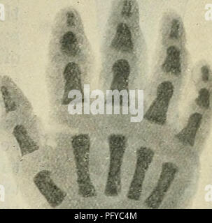 . Cunningham's Text-book of anatomy. Anatomy. Os lunatura inserted, and ...