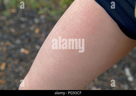 goose bumps (Cutis anserina) on a boy´s thigh, Alpsee, Immenstadt, Allgaeu, Bavaria, Germany Stock Photo