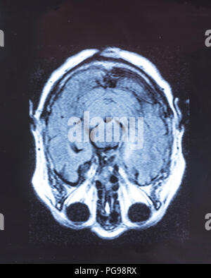 Human brain, magnetic resonance imaging (MRI) scan. Stock Photo
