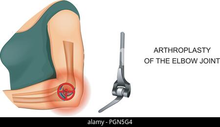 vector illustration of the endoprosthesis of the elbow joint Stock Vector
