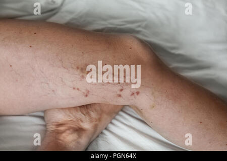 the disease varicose veins on a womans legs Stock Photo