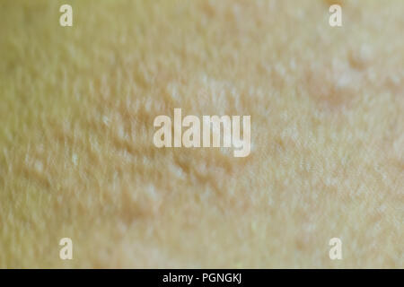 Close up view of cold urticaria allergic rash. Symptoms of itchy urticaria. Stock Photo