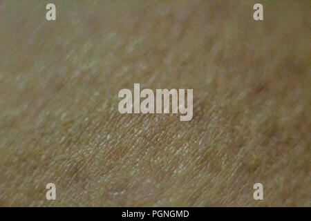 Close up view of cold urticaria allergic rash. Symptoms of itchy urticaria. Stock Photo