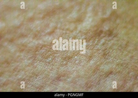 Close up view of cold urticaria allergic rash. Symptoms of itchy urticaria. Stock Photo