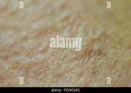 Close up view of cold urticaria allergic rash. Symptoms of itchy urticaria. Stock Photo