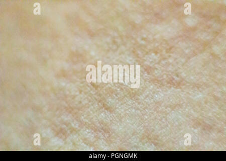 Close up view of cold urticaria allergic rash. Symptoms of itchy urticaria. Stock Photo