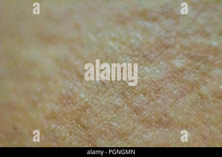 Close up view of cold urticaria allergic rash. Symptoms of itchy urticaria. Stock Photo