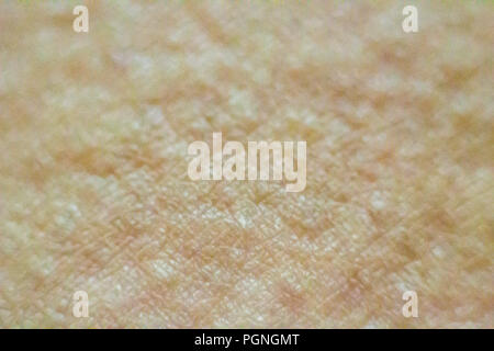 Close up view of cold urticaria allergic rash. Symptoms of itchy urticaria. Stock Photo