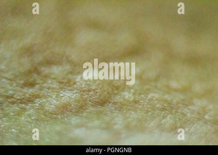 Close up view of cold urticaria allergic rash. Symptoms of itchy urticaria. Stock Photo