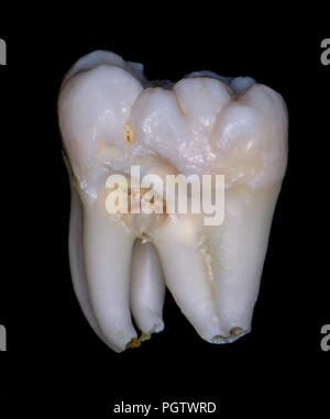 wisdom tooth, lower left molar, extra large, two tooth in one, fusion ...