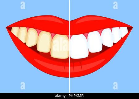 Teeth whitening concept on smile. Stock Vector