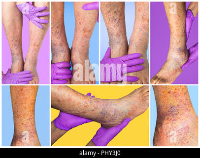 Close up varicose spider vein on skin crook leg elderly woman, Problem ...