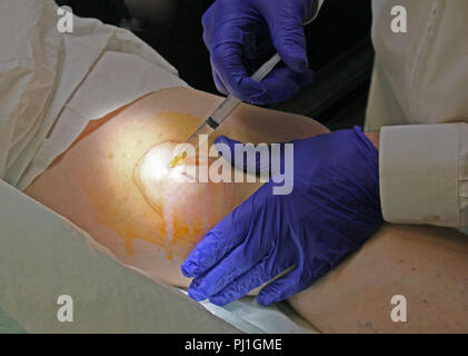 injection for local numbing or anesthesia Stock Photo