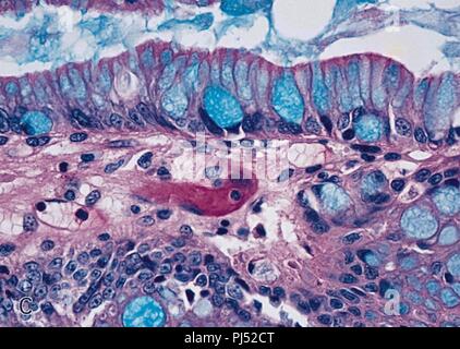 Barrett's mucosa higher magnification Alcian blue stain Stock Photo - Alamy