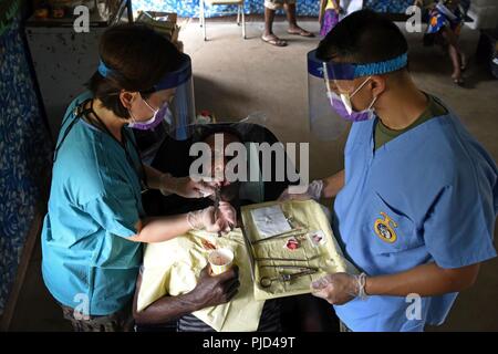 U.S. Navy Lt. Denise Chiu, dentist, and Hospital Corpsman 3rd Class Allan Callanta, dental technician, with the 1st Dental Battalion, Camp Pendleton, Calif., extract a patient’s tooth at Tata Primary and Secondary School during Pacific Angel 18-3 in Luganville, Espiritu Santo Island, Vanuatu, July 16, 2018. The dental team worked together to pull almost 180 teeth during the first two days of the clinic. Stock Photo