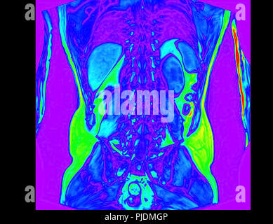 Frontal abdomen MRI scan of 60 year old male patient with kidney stone Stock Photo