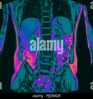 Frontal abdomen MRI scan of 60 year old male patient with kidney stone Stock Photo