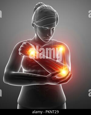 Woman with arm pain, computer illustration. Stock Photo