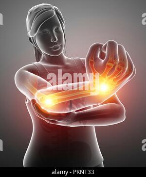 Woman with arm pain, computer illustration. Stock Photo