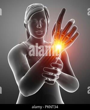 Woman with wrist pain, computer illustration. Stock Photo