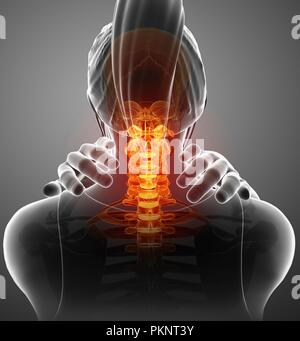 Woman with neck pain, computer illustration. Stock Photo