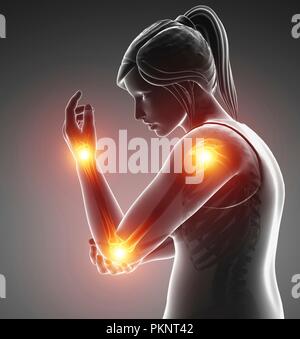 Woman with arm pain, computer illustration. Stock Photo