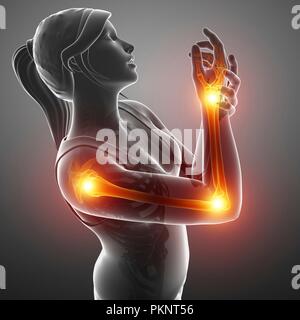 Woman with arm pain, computer illustration. Stock Photo