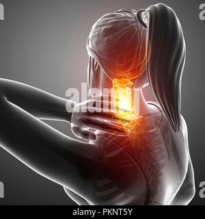 Woman with neck pain, computer illustration. Stock Photo