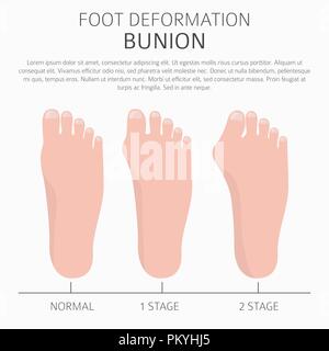 Foot deformation as medical desease infographic. Causes of bunion ...