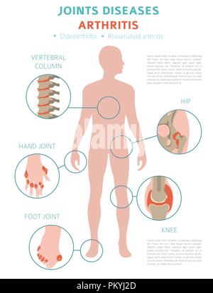Joints diseases. Arthritis, osteoarthritis symptoms, treatment icon set ...