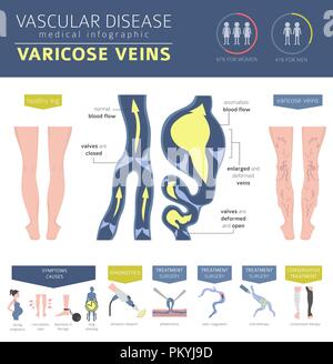 Vascular diseases. Varicose veins symptoms, treatment icon set. Medical infographic design. Vector illustration Stock Vector