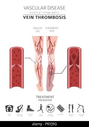 Vascular diseases. Vein thrombosis symptoms, treatment icon set. Medical infographic design. Vector illustration Stock Vector