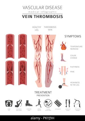 Vascular diseases. Vein thrombosis symptoms, treatment icon set. Medical infographic design. Vector illustration Stock Vector