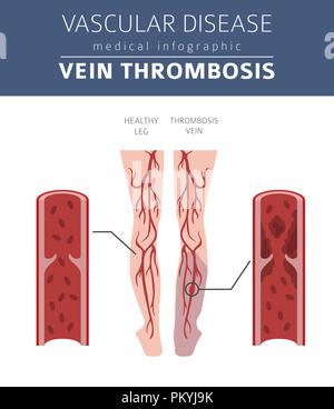 Vascular diseases. Vein thrombosis symptoms, treatment icon set. Medical infographic design. Vector illustration Stock Vector