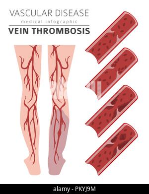 Vascular diseases. Vein thrombosis symptoms, treatment icon set. Medical infographic design. Vector illustration Stock Vector