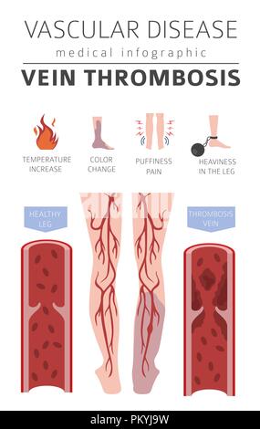 Vascular diseases. Vein thrombosis symptoms, treatment icon set. Medical infographic design. Vector illustration Stock Vector