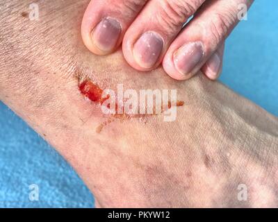 Doctors hand healing a burned skin area.  Hand embracing injured  place with painful abrasion scratches from accident. Stock Photo