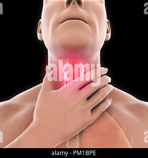 Sore Throat Illustration Stock Photo