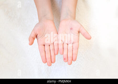 The hand of a child with chickenpox in her mother's hand. Blisters on the hand from chickenpox. Stock Photo