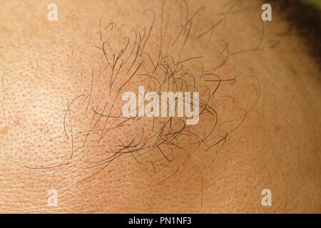 Few Hairs at Bald Head Baldness Problem Stock Photo