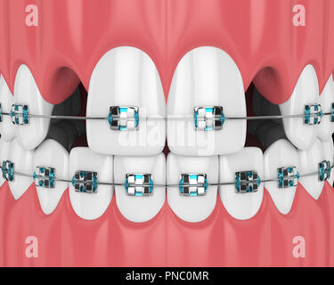 Tooth cavity close up and cavities symbol showing a magnifying glass ...