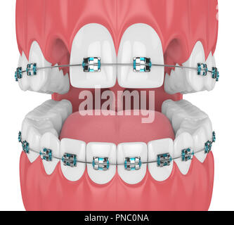 Tooth cavity close up and cavities symbol showing a magnifying glass ...