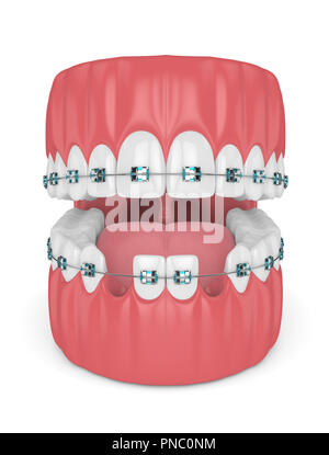 Tooth cavity close up and cavities symbol showing a magnifying glass ...