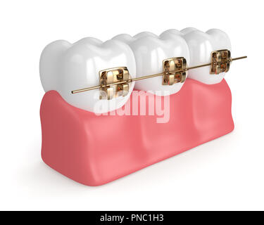 3d render of teeth with golden orthodontic braces isolated over white ...