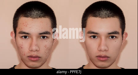 Acne problem. Young man before and after treatment on white background ...